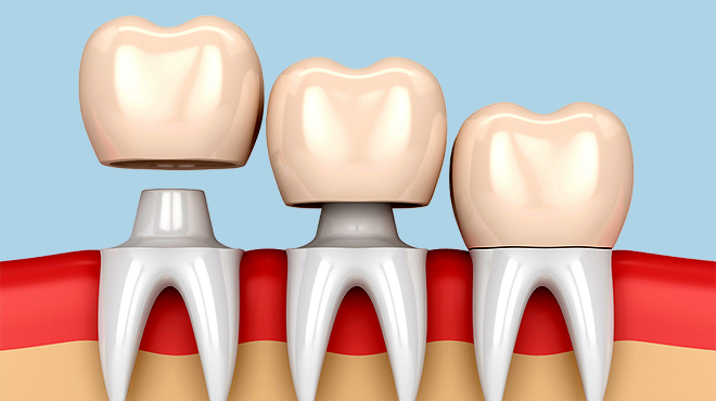 Dental Crowns in Oakville