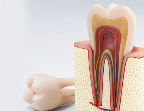 Root Canal Therapy in Oakville: What It Is and Why It Can Save Your Tooth